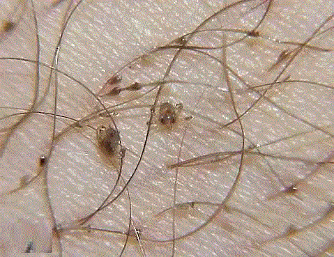 图源：Primary Care Dermatology Society,夭寿啦：六种可能在你眼中出现的生物,夭寿,眼中,生物,蜜蜂,图源,汗液,医生,蜱虫,虫子,眼睑