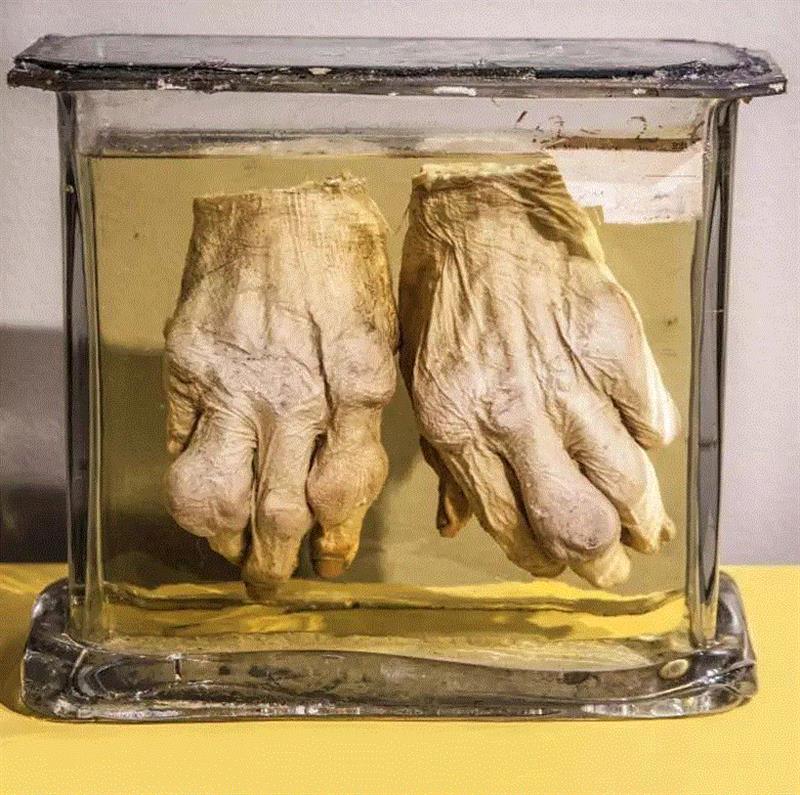 这对人类双手是托马斯·登特·穆特医生收藏的一件19世纪标本。它向人们展示了身患“痛风”后的症状——穆