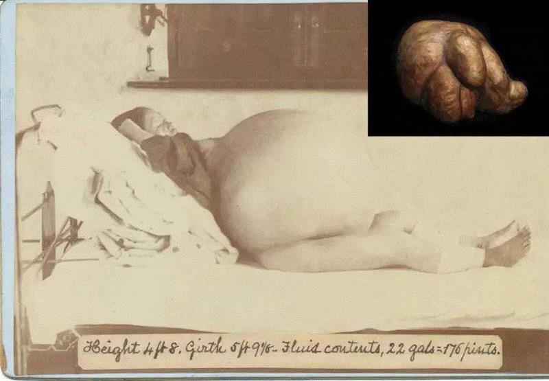 1865年，当这个捐赠给穆特博物馆的卵巢囊肿刚在外科手术中被切除时，重达74磅（约33.6千克）。令
