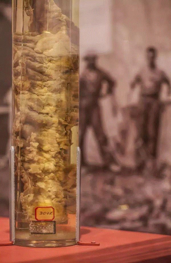 这是一具供实验室研究使用的感染了痢疾（伴随着出血的严重腹泻症状）的结肠湿标本——痢疾是19世纪末20