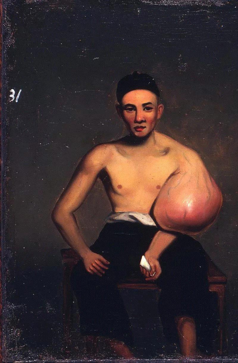 关乔昌的31号画像人物——卜阿兴。图源：Yale University,一个清朝人笔下的畸形人间,画像,肿瘤,关乔昌,帕克,图源,医院,病人,肖像,拉赫曼,传教士