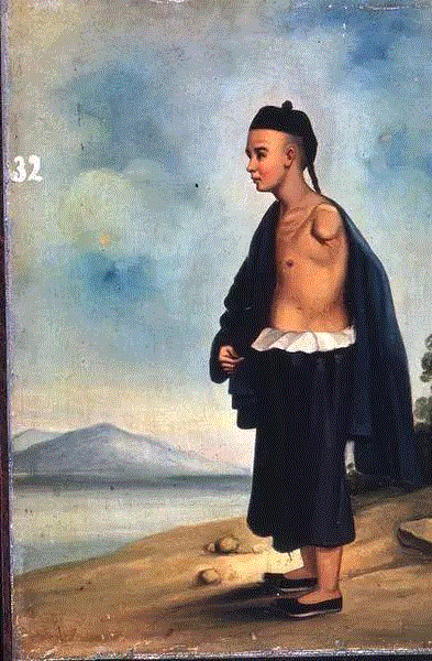 卜阿兴术后的画像。图源：Yale University,一个清朝人笔下的畸形人间,画像,肿瘤,关乔昌,帕克,图源,医院,病人,肖像,拉赫曼,传教士