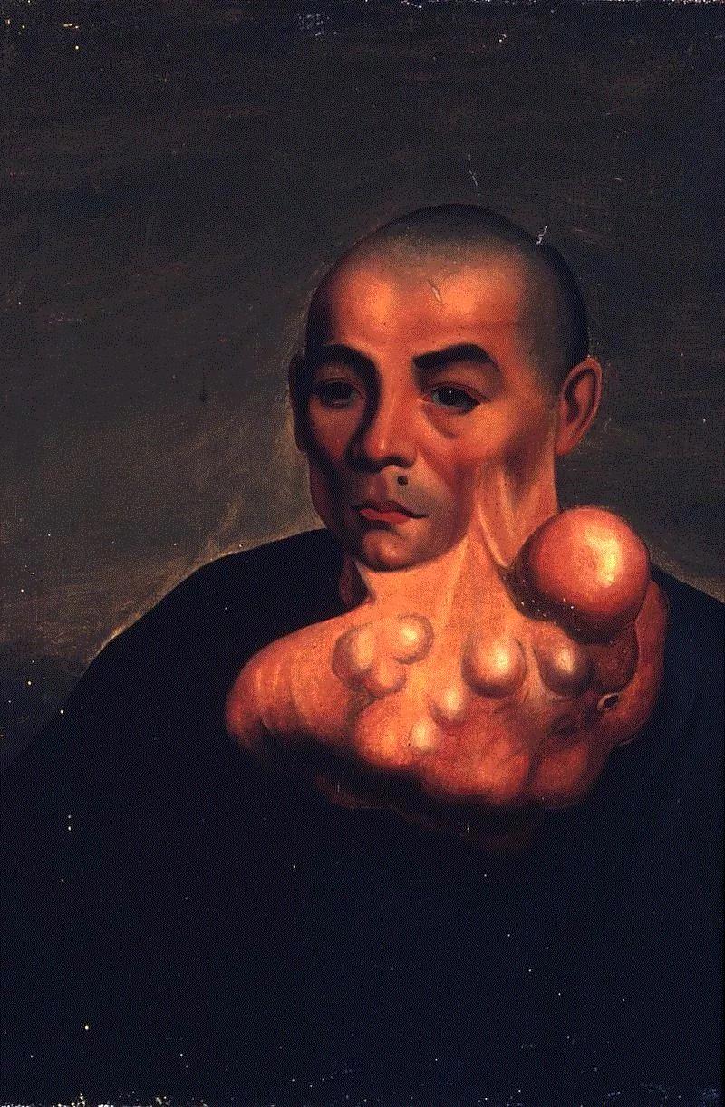 一个清朝人笔下的畸形人间,画像,肿瘤,关乔昌,帕克,图源,医院,病人,肖像,拉赫曼,传教士