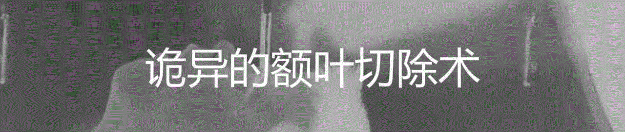 电击疗法被污名化了吗？,电击疗法,电痉挛疗法,患者,医生,抑郁症,疗法,图源,电流,症状,电影