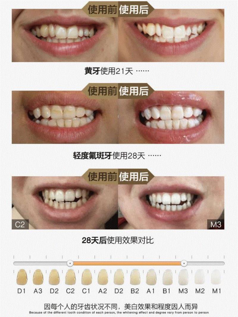▲ 第一次使用后，牙齿白了两个色度。,几十年小黄牙，贴它就白了