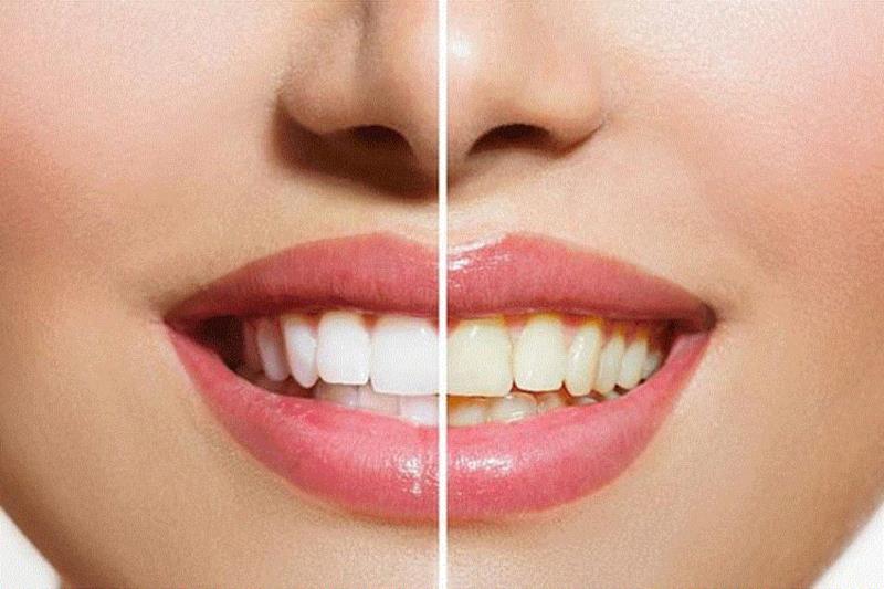 几十年小黄牙，贴它就白了