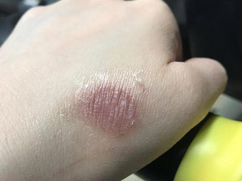 给大家直观展现一下皮肤上的这层“保护膜”,薄薄涂一层，烫伤、晒伤好得快